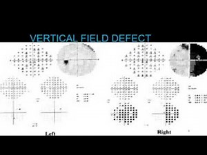 OCT interpretation, a beginners guide.